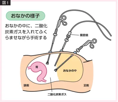 高齢者も安心！腹腔鏡手術の特徴と最新医療の進歩を外科医が解説