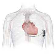 群馬大医学部付属病院が県内初の新型植え込み型除細動器手術に成功、小児にも適応可能に