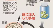 iPS細胞由来再生医療製品「アムセプリ」、保険適用へ　年内に実用化
