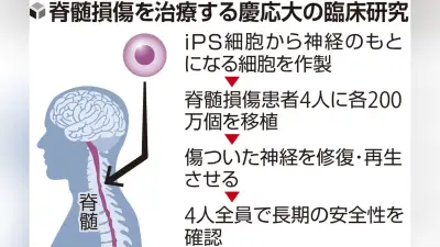 iPS細胞移植、脊髄損傷患者で最長4年観察 腫瘍なし