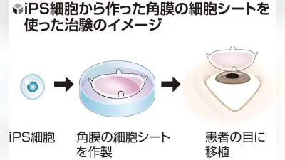 ｉＰＳ角膜治験開始、レイメイが１例目手術　２０２８年承認申請へ