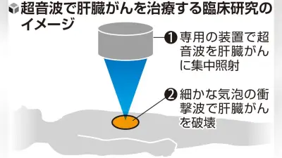 超音波で肝臓がん細胞破壊、大阪公立大が国内初の臨床研究開始