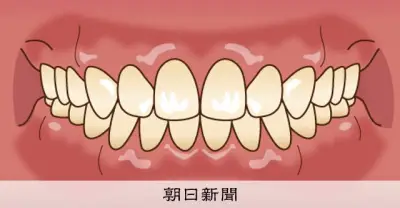 睡眠時の口呼吸とかまない食事、小学生の歯並び悪化リスクに