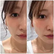 あいのり桃、41歳で糸リフト施術のビフォーアフター公開「違いが凄い」と反響