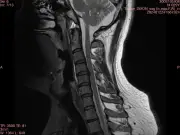 慢性的な腰痛が初期症状？スティッフパーソン症候群の男性、死を意識する激痛