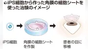 ｉＰＳ角膜治験開始、レイメイが１例目手術　２０２８年承認申請へ