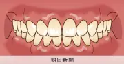 睡眠時の口呼吸とかまない食事、小学生の歯並び悪化リスクに