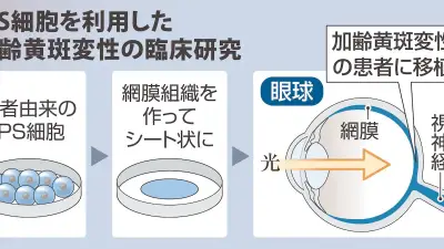 iPS細胞20年、高橋政代氏「承認はゴールではない」 世界初の移植から標準治療への道