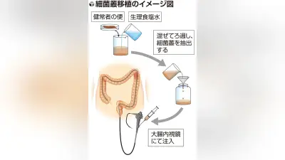 小児の再発性CD腸炎に便移植治療、香川大病院が成功…1年半再発なし