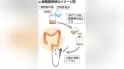小児の再発性CD腸炎に便移植治療、香川大病院が成功…1年半再発なし